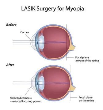 Lasik eye surgery for myopia Illustrazione stock