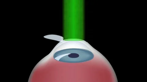 Lasik eye surgery procedure Stock Footage