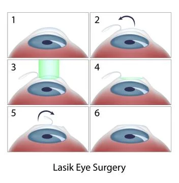 Lasik eye surgery procedure Stock Illustration
