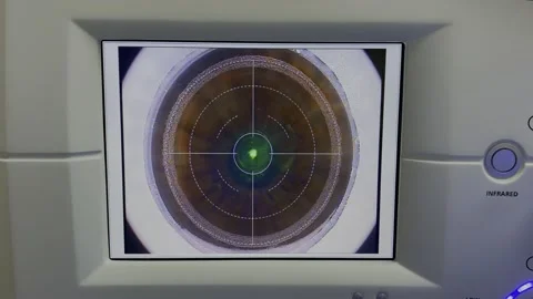 Lasik operation for treating refractive errors Stock Footage 158909477