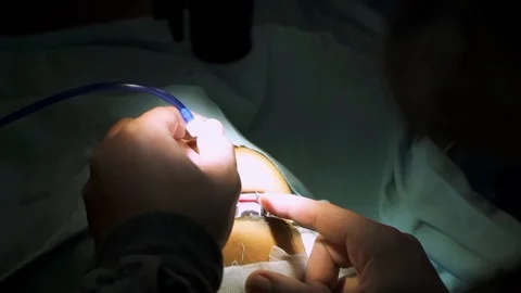 LASIK sergery preperations Vídeo Stock 123719542