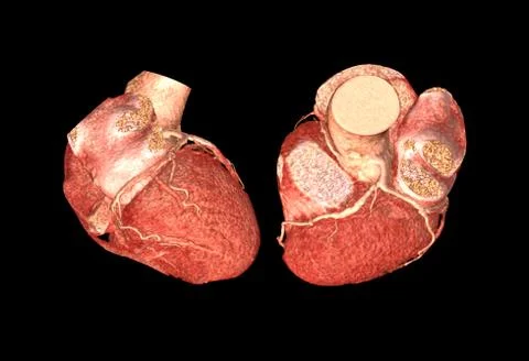 Lateral ad Top view of CTA Coronary artery  3D rendering image isolated o bla Illustrazione stock
