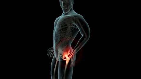 Lateral Hip Pain 스톡 동영상 121786285
