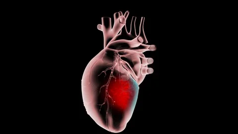 Lateral Myocardial Ischemia Stock Footage 122568751