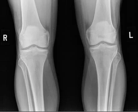 Lateral-view X-ray of 53-year-old caucasian man's knee. Stock Photos