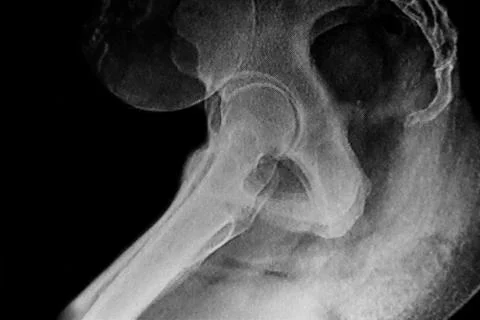 Lateral view of x-ray image of a pelvimetry Stock Photos