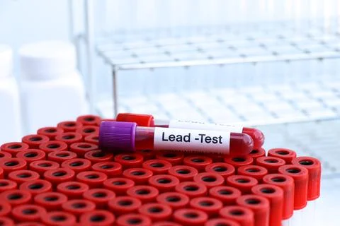 Lead test to look for abnormalities from blood Stockfoto's