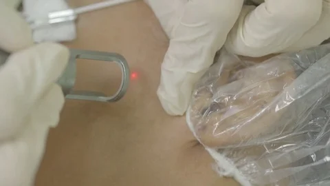 Leaser Treatment Video stock 79021045