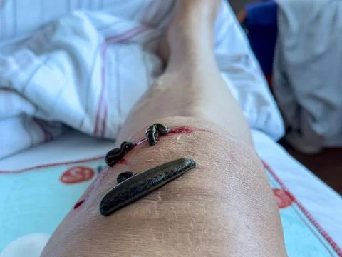 Leech therapy on the knee Stock Photos
