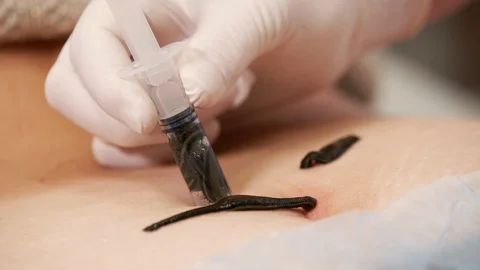 Leech treatment Vídeos de archivo 104404917