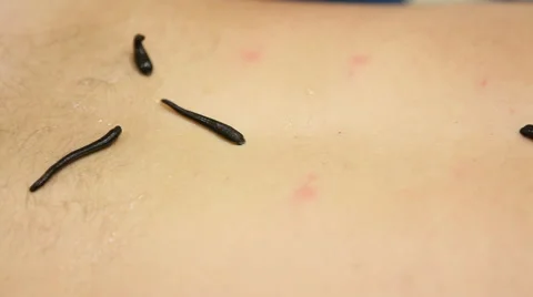 Leeches on the human body Stock Footage 47000667