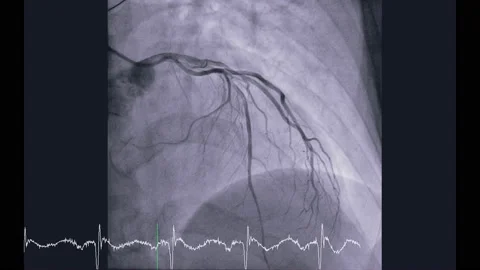 Left coronary artery cath. Stock Footage 150555634