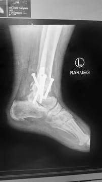 Left foot ankle replacement hardware - plain x ray Stock Photos