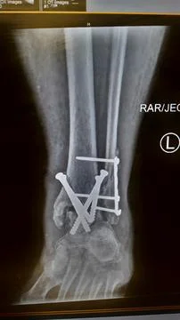 Left foot ankle replacement hardware - plain x ray Stock-Fotos