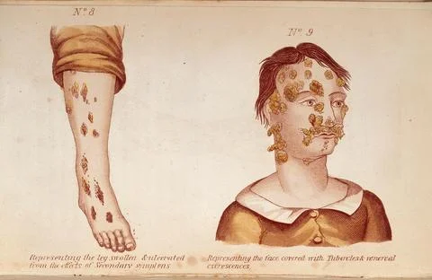 (Left) Representing the leg swollen and ulcerated from the effects of Secon.. Stock Illustration
