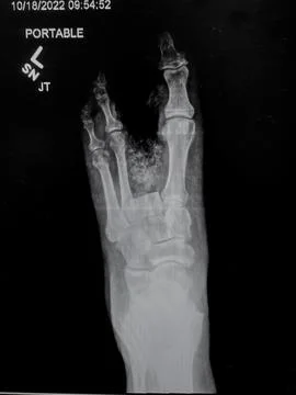 Left second and third toe ray resections - plain x-ray Stock-Fotos