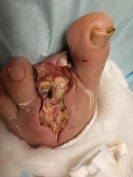 Left second and third toe open amputation wound Stock Photos