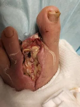 Left second and third toe open amputation wound Foto stock