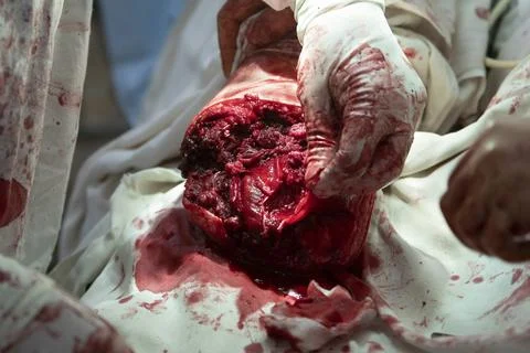 Leg After Amputation Photos