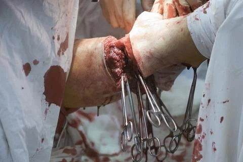 Leg Amputation Process CU Photos