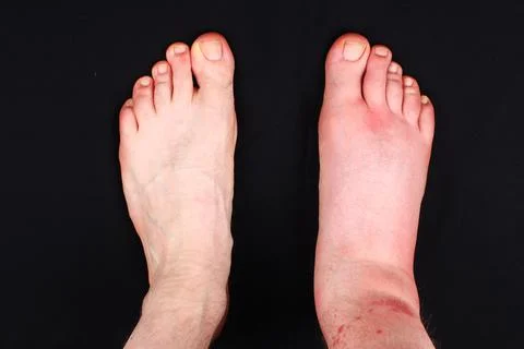 The leg bitten by a bee Stock Photos