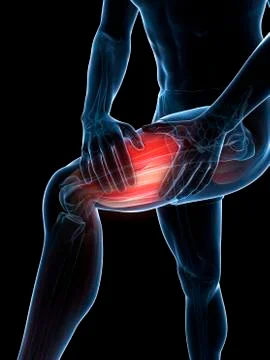 Leg cramp, artwork Stock Illustration