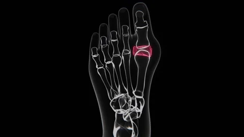 Leg Gout in Vertical HD Video | Leg Gout Indication X-Ray in HD Video Stockbeeldmateriaal 330922075