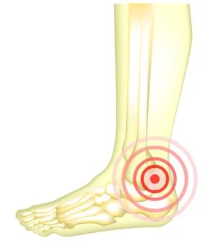 Leg pain Stock Illustration