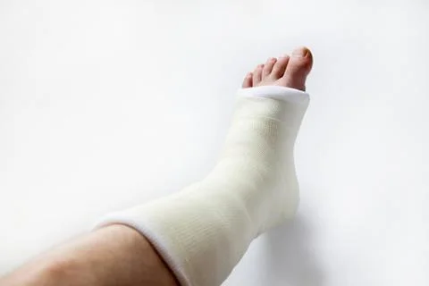 Leg in plaster Stock Photos