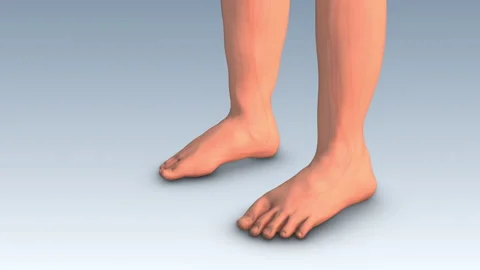 Leg swelling or lower limb edema Stock Footage 261813672