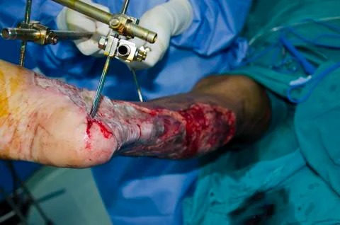 Leg ulcers Stock Photos