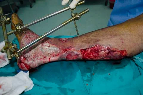 Leg ulcers Stock Photos