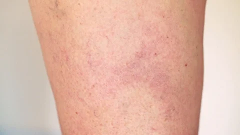Leg with varicose Stock-Footage 91724322