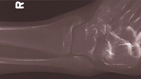 Leg x-ray human bones close up ankle and foot bone structure of right leg. Human Stock Footage 136640860