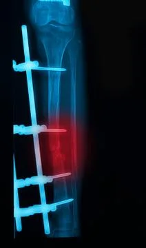 Leg x-rays image showing plate and screw external fixation tibia and fibula b Stock Photos