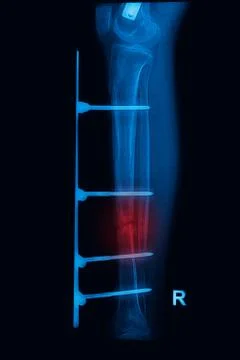 Leg x-rays image showing plate and screw external fixation tibia and fibula b Stock Photos