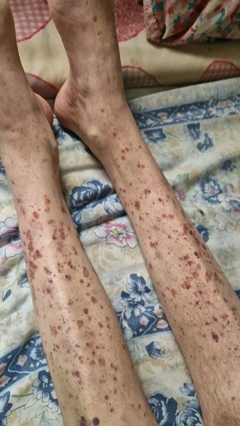 Legs with Skin Condition on Bed Sheets Stock Footage 318355422