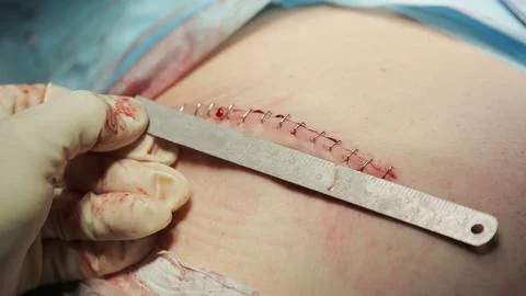 Length of the Suture 写真素材