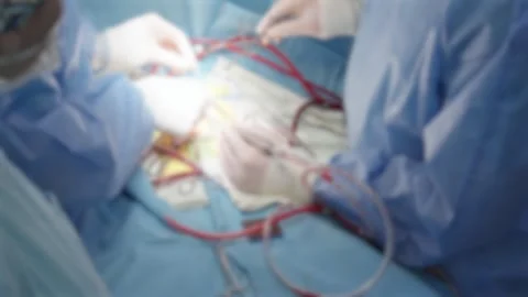 Lens blurred view, heart complex surgery process, close up of surgeons hands Stock Footage 311511869