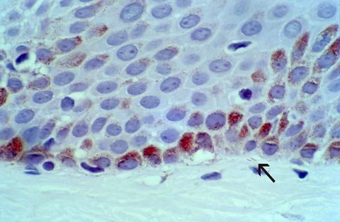 Leprosy: acid-fast bacilli Stock Illustration