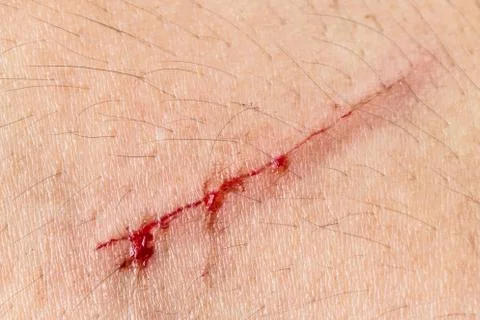 Lesion on arm Stock Photos