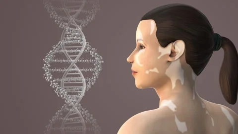 Leucoderma or Vitiligo caused by hormonal imbalance Stock Footage 265251356
