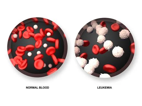 Leukemia vs Normal Blood 스톡 일러스트