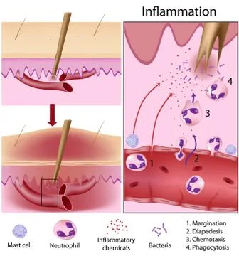 Leukocytes and inflammation Stock Illustration