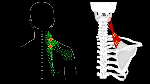 Levator scapulae muscle. Trigger points and muscle structure. Pain in the neck Stock Illustration