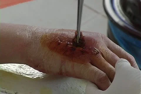 Ligation Stock Footage 10793895