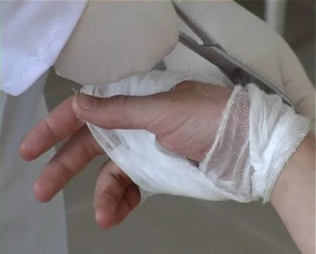 Ligation Stock Footage 10793897