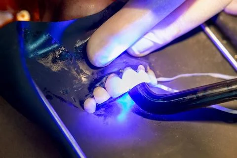 Light curing porcelain veneers after adhesive cementation Stock Photos