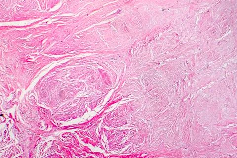 Light micrograph of scar tissue Stock Photos