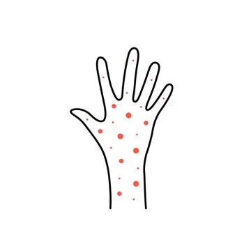 Linear hand with rash or psoriasis Stock Illustration